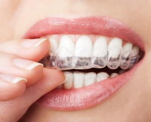 A women putting her clear aligners on her teeth